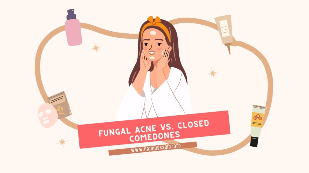 Fungal Acne vs. Closed Comedones