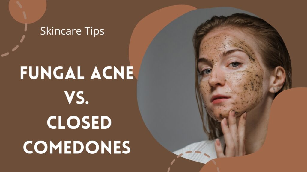 Fungal Acne vs. Closed Comedones