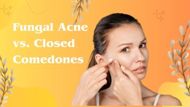 Fungal Acne vs. Closed Comedones